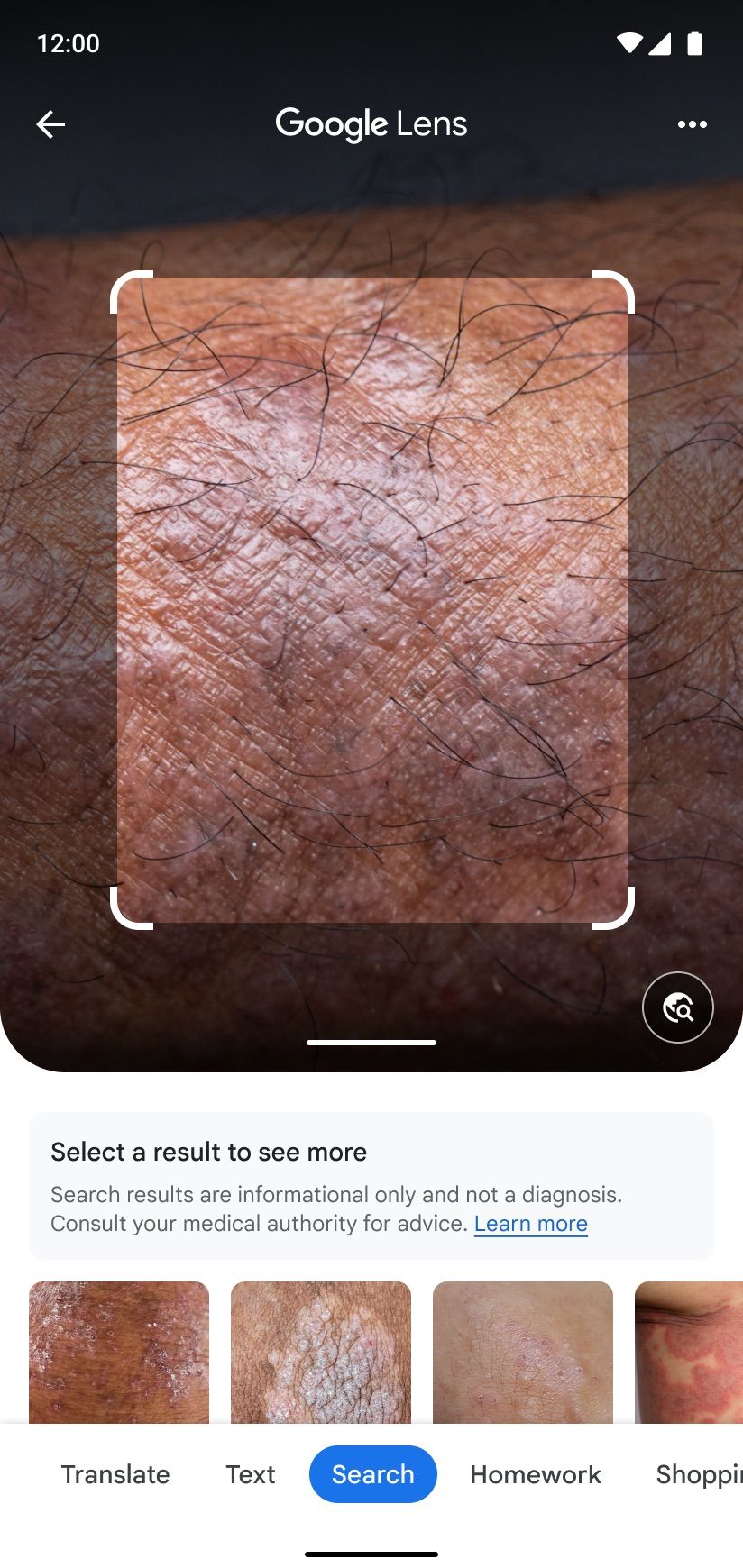 Google Lens can tell you what skin condition you have