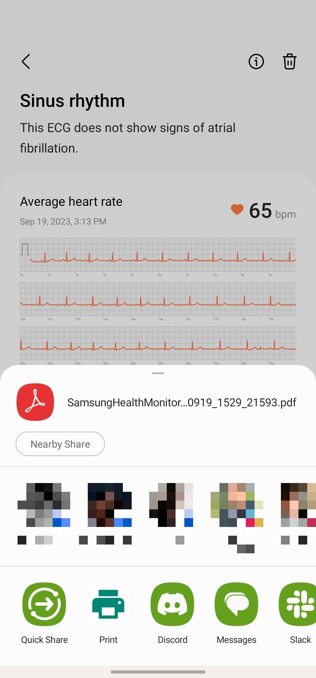 ECG results in the Samsung Health Monitor mobile app, with the share menu opened.